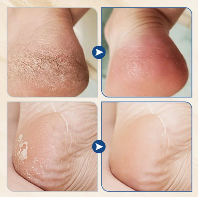 ⏳ Zeitlich begrenztes Angebot ✨ Urea Feuchtigkeitscreme – Intensive Feuchtigkeit für weichere, gepflegte Füße 💧